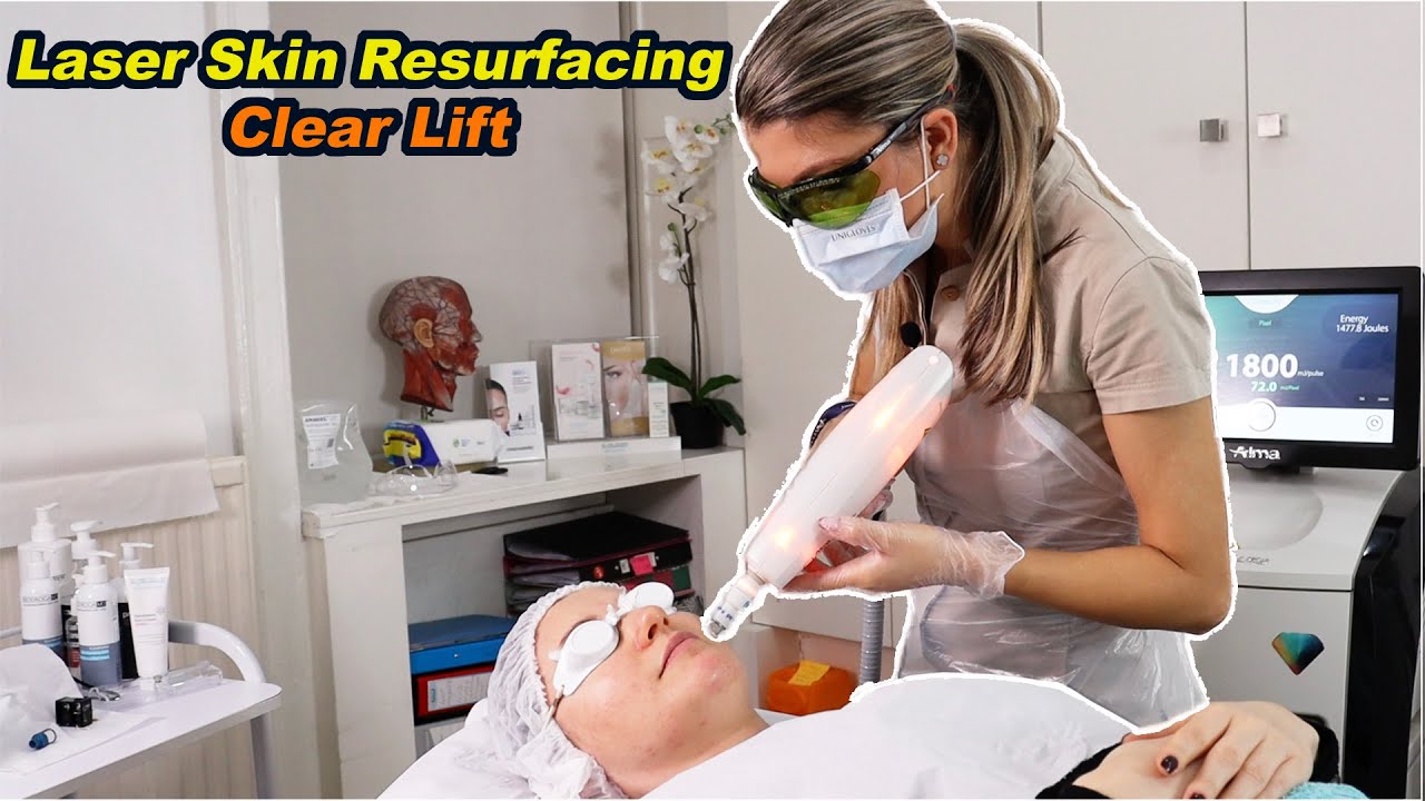 Laser Skin Resurfacing - by Clear Lift - Harmony XL Pro - best full demo + treatment fully explained