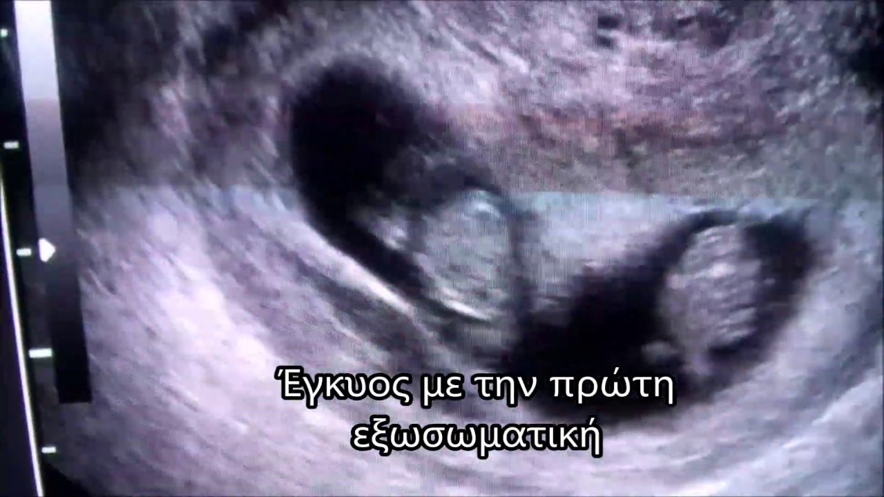 ΕΓΚΥΟΣ ΜΕ ΤΗΝ ΠΡΩΤΗ ΕΞΩΣΩΜΑΤΙΚΗ  | Pregnancy with IVF | Dr. Παναγιώτης Καλιαντζής