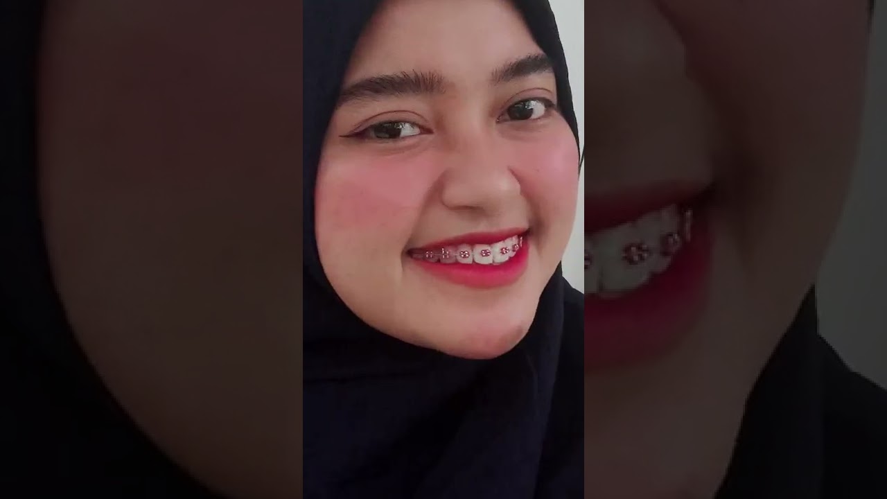 Setelah pake behel 12thn akhirnya gigi ku terbebas🤟🏻 siapa disini yang masih #pejuangbehel ??