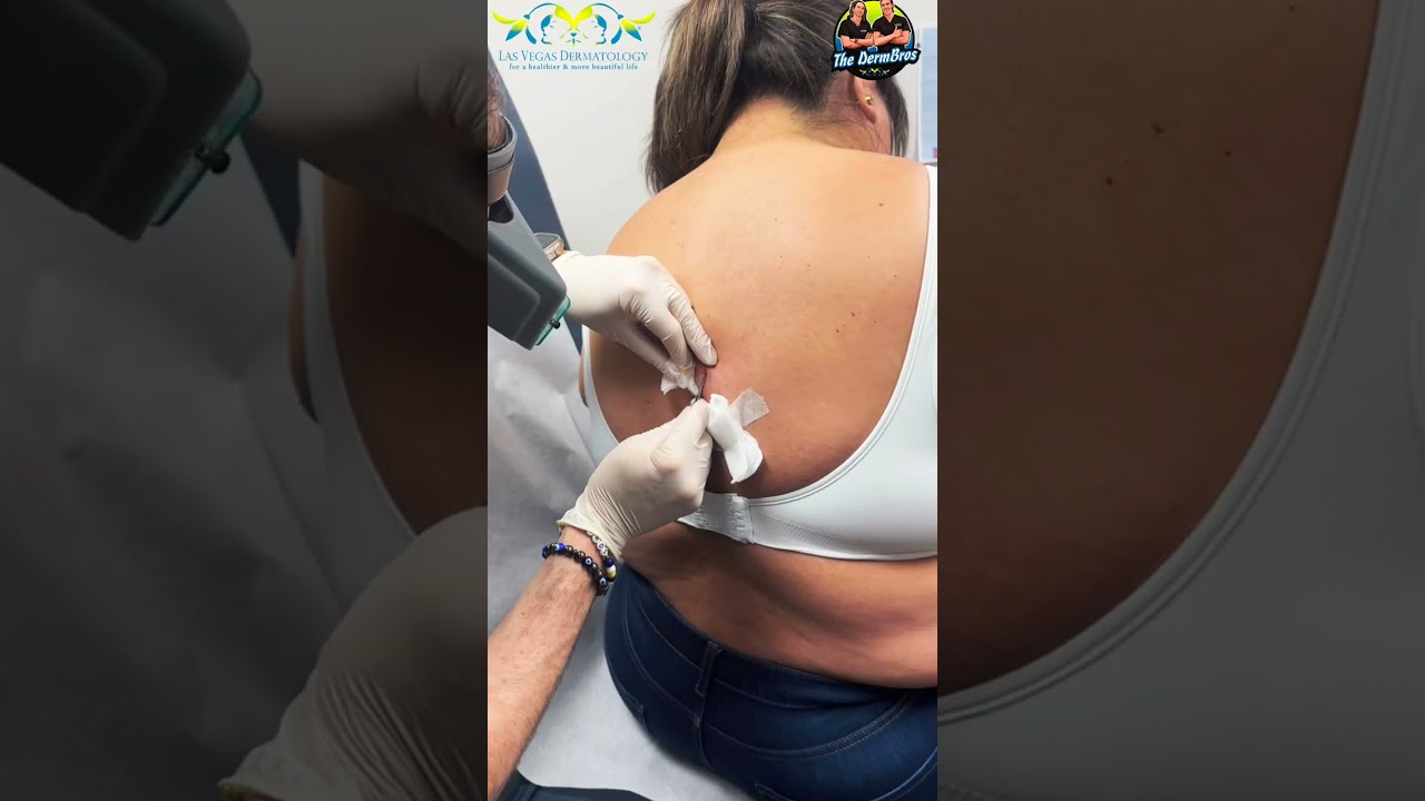 Cyst Treatment by Dr. H.L. Greenberg at Las Vegas Dermatology&reg; utilizing Incision & Drainage