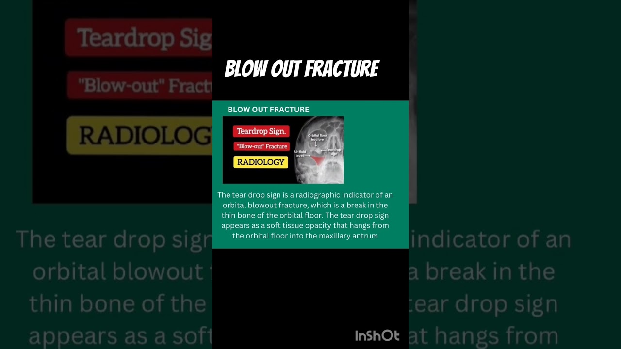 Blow out Fracture #aiapgetpreparation #medicallectures #shorts #neetpg