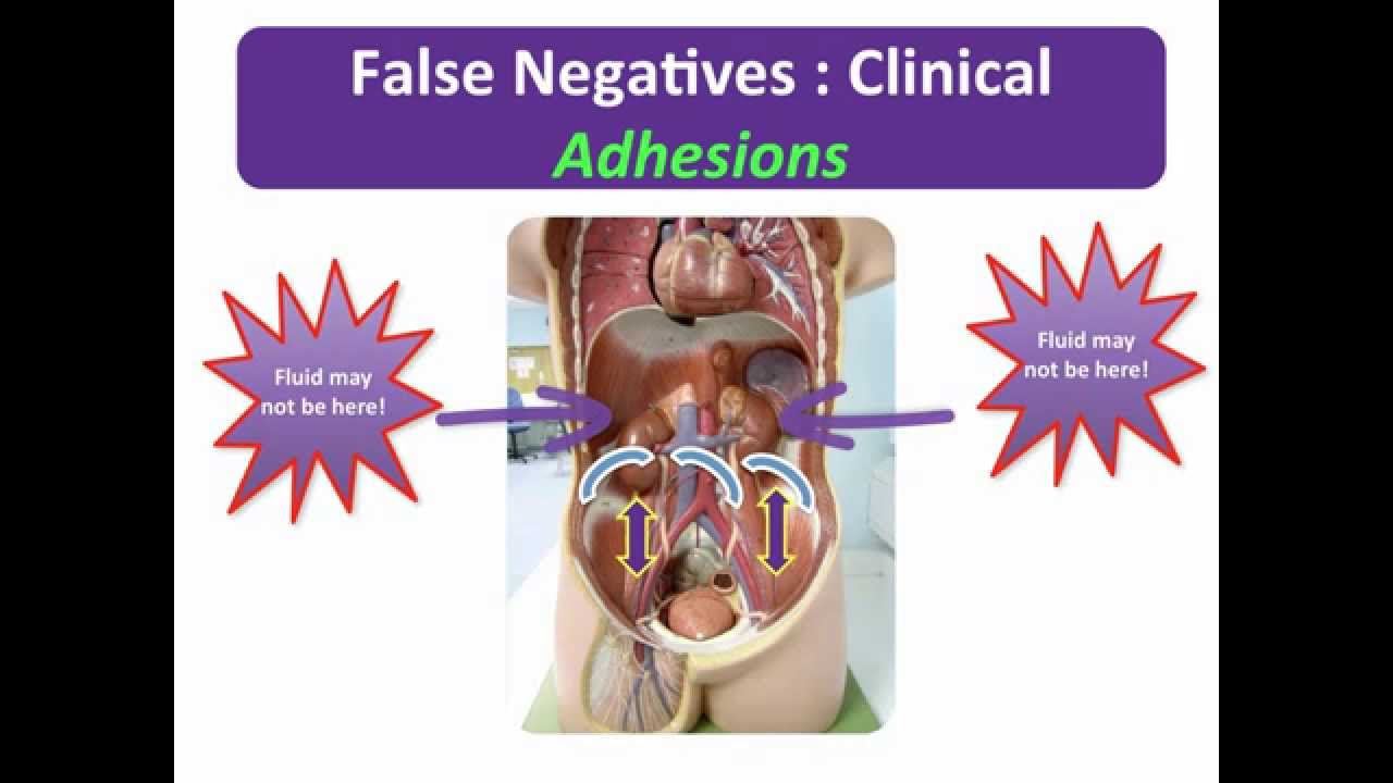 FAST II - Potential Pitfalls