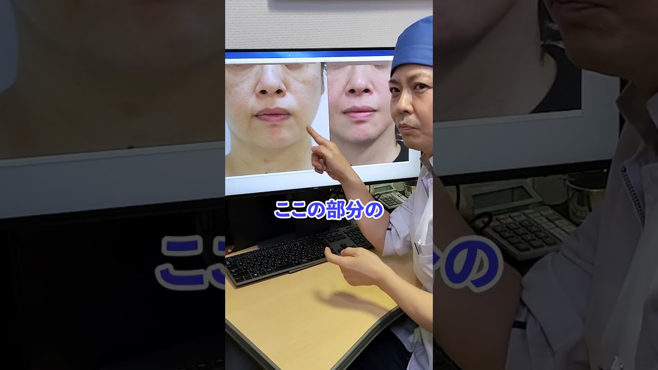 【口元が劇的に若返る】マリオネットラインを消す方法 #shorts