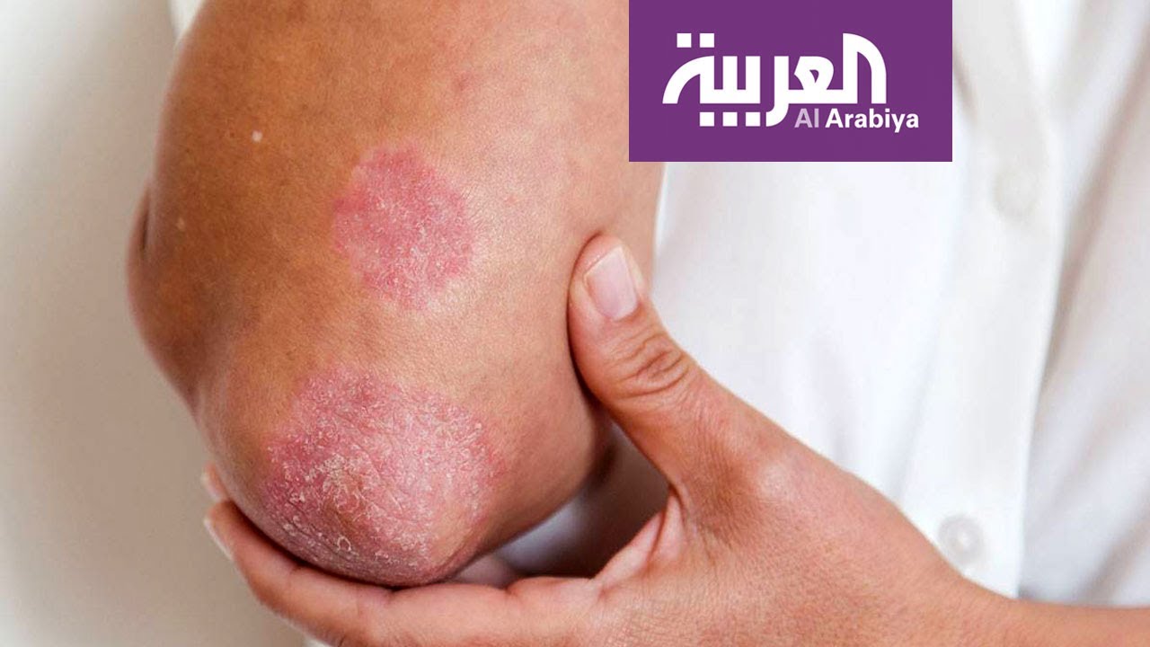 أحدث علاجات الصدفية