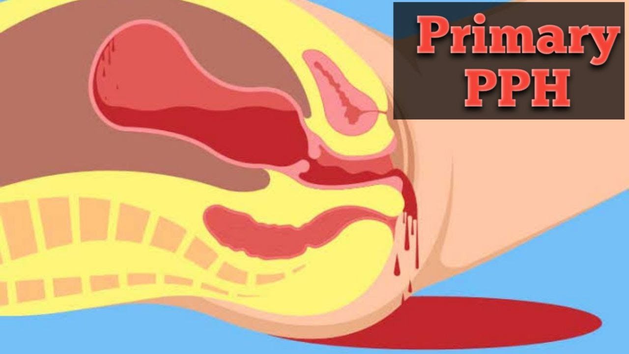 Primary postpartum hemorrhage