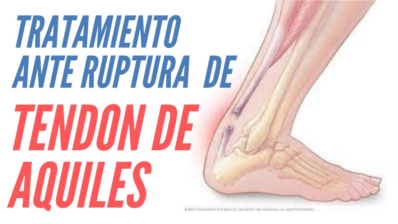 Tratamiento ante RUPTURA de tendon de Aquiles - parte 2