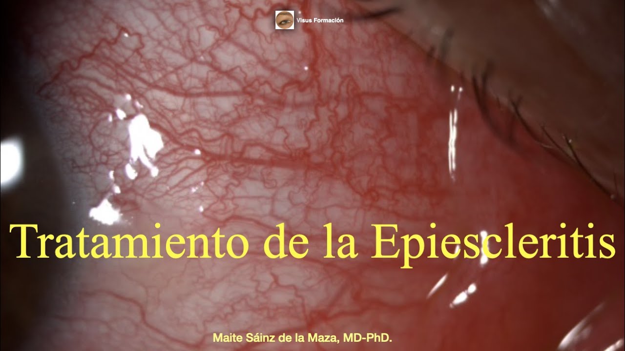Treatment of Episcleritis.
