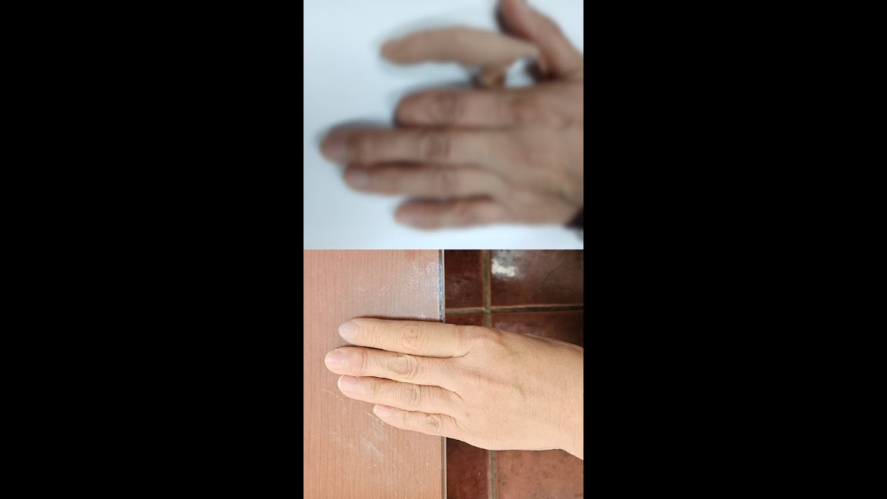 어렸을 때 손가락 절단으로 의수 제작