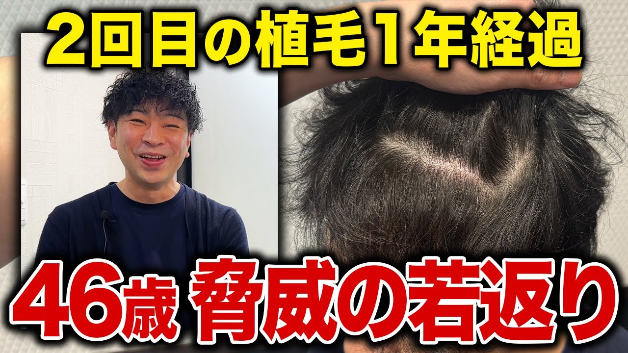 【−10歳若返り】40代の薄毛男性が2回目の植毛をして1年経過した姿が別人！