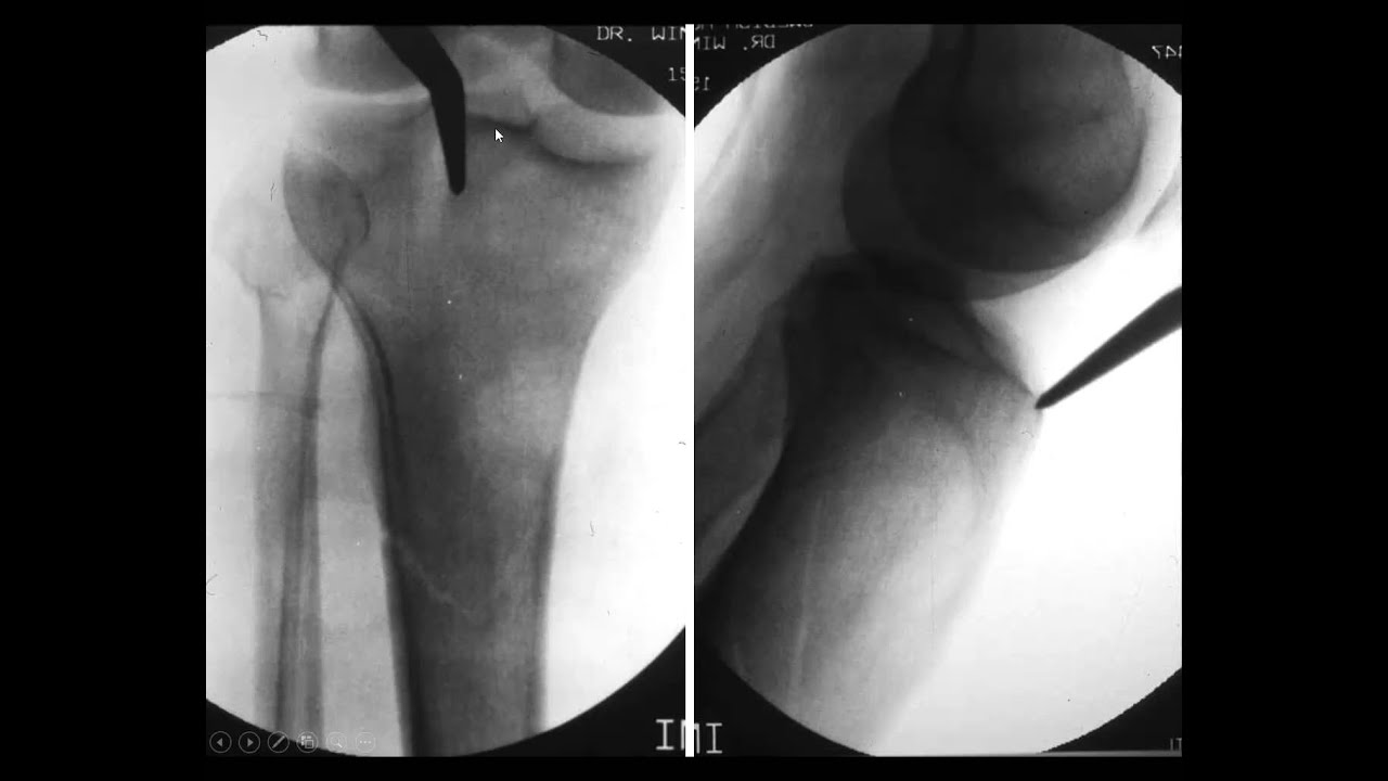 Tibial Shaft 1