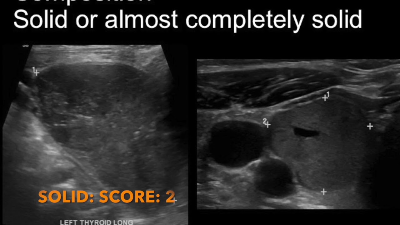 TMT: NECK USG by Alka Singhal: Intro to TIRADS