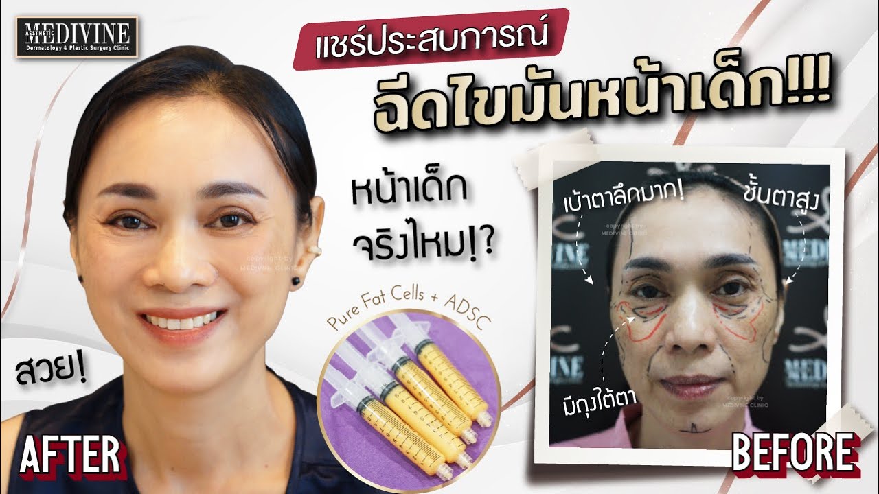 พลีชีพ..รีวิวฉีดไขมันหน้าเด็ก! แก้เบ้าตาลึก หน้าตอบโทรม คืนหน้าเด็ก เติมเต็มความสาวอีกครั้ง