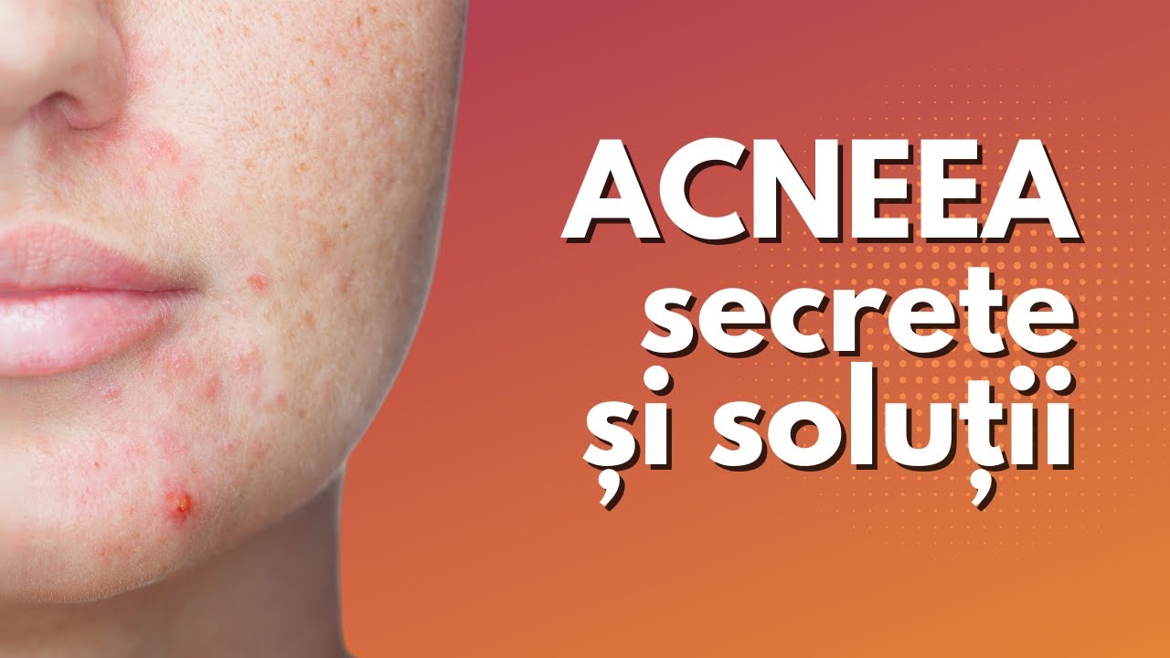 ACNEEA - secrete și soluții | Dr. Teodora Predescu | Sănătate cu prioritate