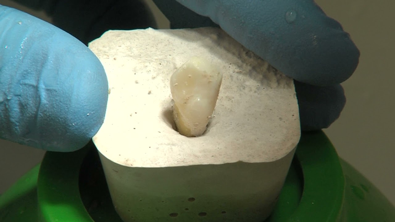 OPERATORIA DENTAL Y ENDODONCIA: TÉCNICAS Y MATERIALES_13. APERTURA DE CÁMARA DEL SECTOR ANTERIOR.