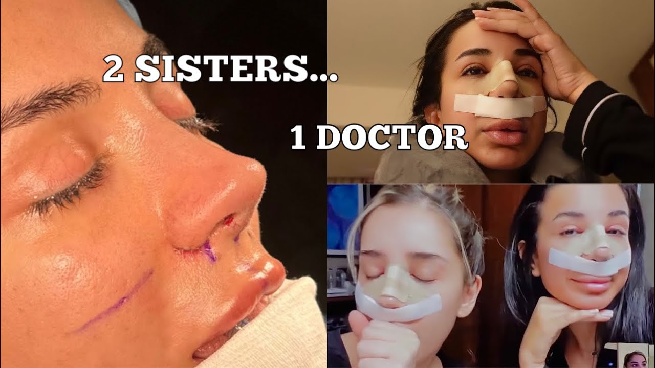 I GOT A NOSE JOB...AGAIN!! | rhinoplasty in Turkey PART 1 - (Dr Emrah Celik)