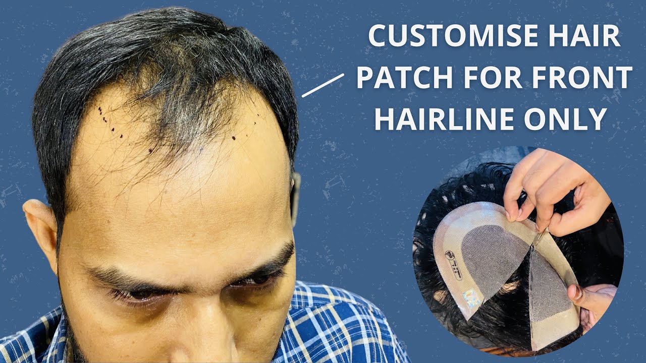 Customise Hairline Patch for Front Only | Non surgical Hair Replacement in India | Hair Wig House