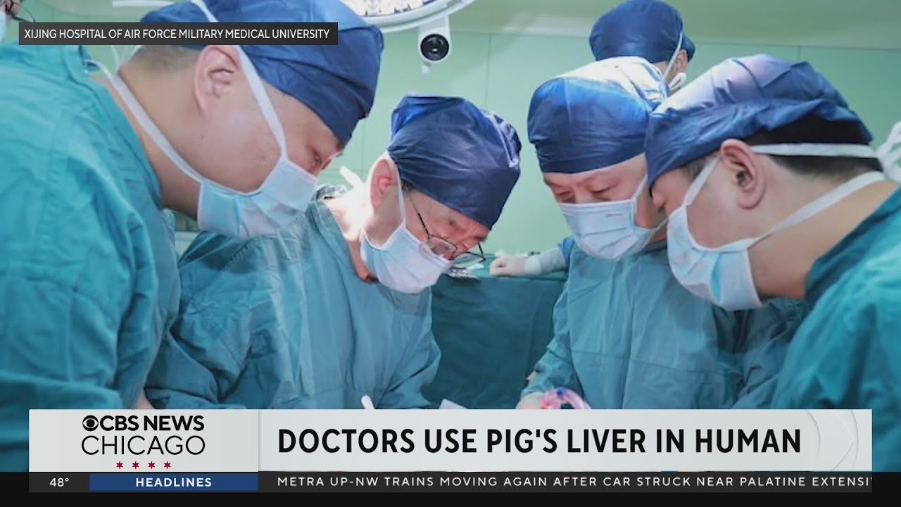 Doctors in China transfer pig's liver into human