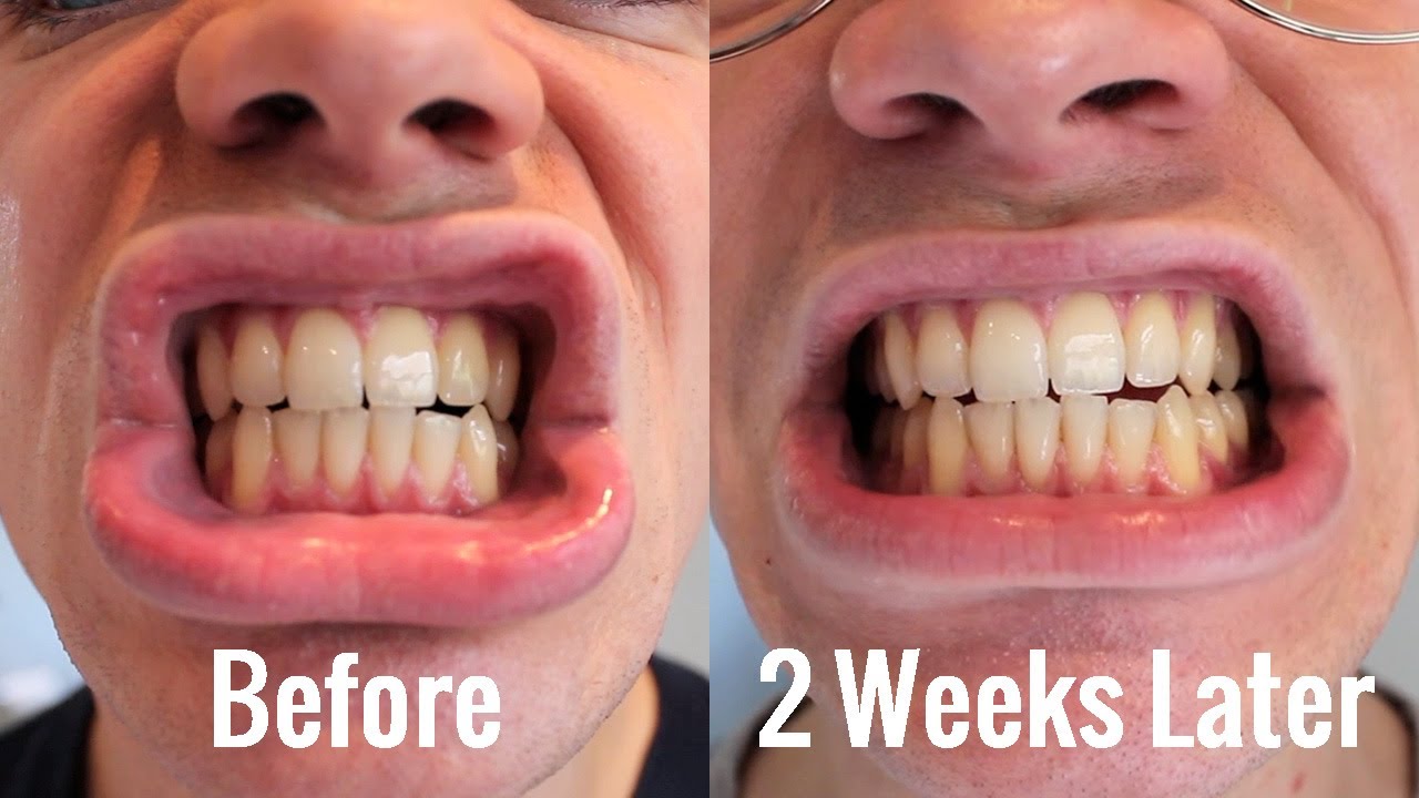Teeth Whitening | BlanX White Shock with LED Bite | Review