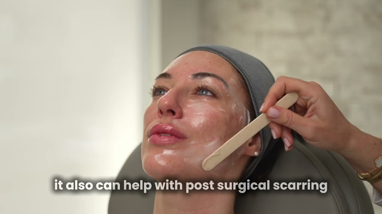 CO2 Laser Treatment EXPLAINED 🔥 What REALLY Happens at Vbeauty Medical Spa