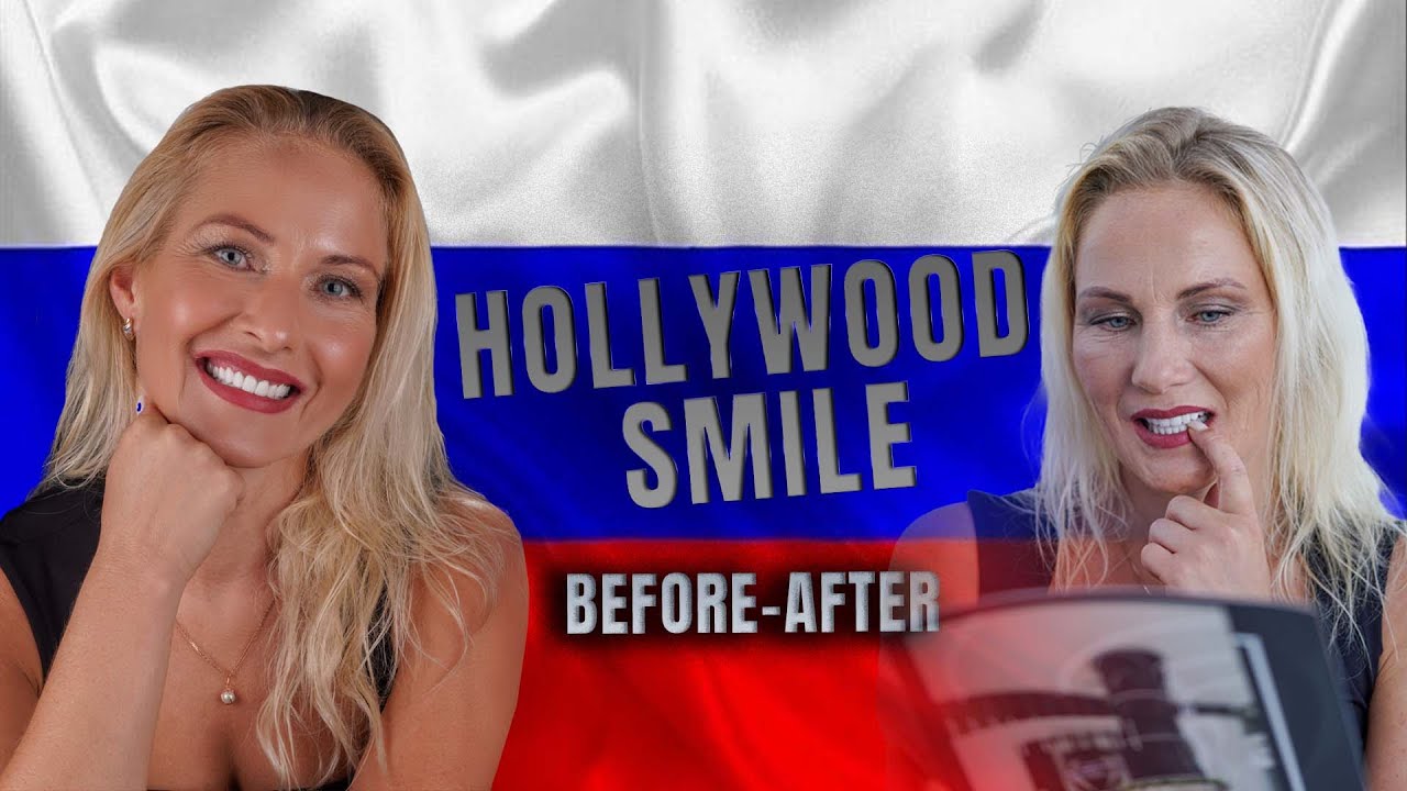 Hollywood Smile Before - After #internationalplus #perfectsmile