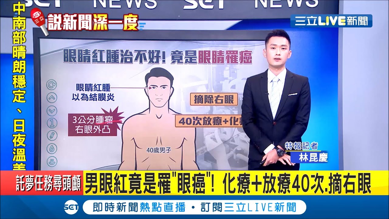 眼睛紅腫以為是一般結膜炎 就醫檢查竟罹患