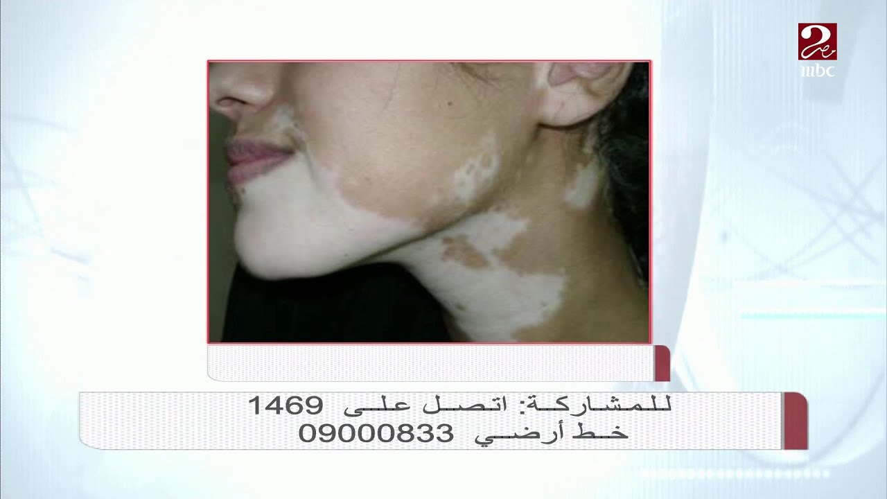 هل تغطية البهاق بمستحضرات التجميل يسبب أي ضرر؟ د. عاصم فرج يوضح