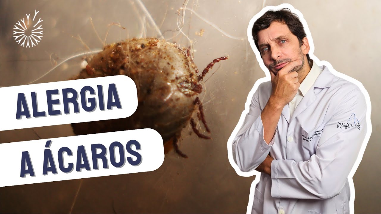 ALERGIA A ACARO E POEIRA. Alergista orienta diagnóstico e tratamento.  #alergias #ácaros  #rinite