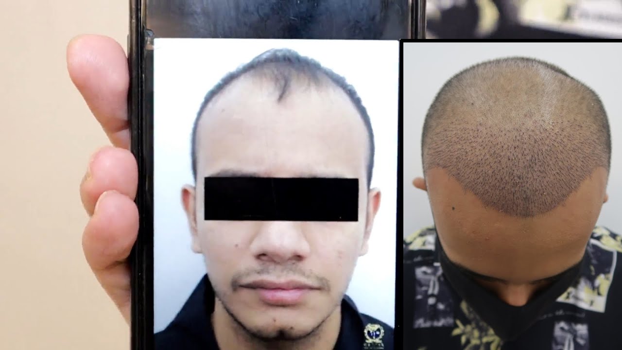 SMART™ FUE Hair Transplant ( 7 Days ) Result Testimonial @ Hair Transplant Malaysia Specialist
