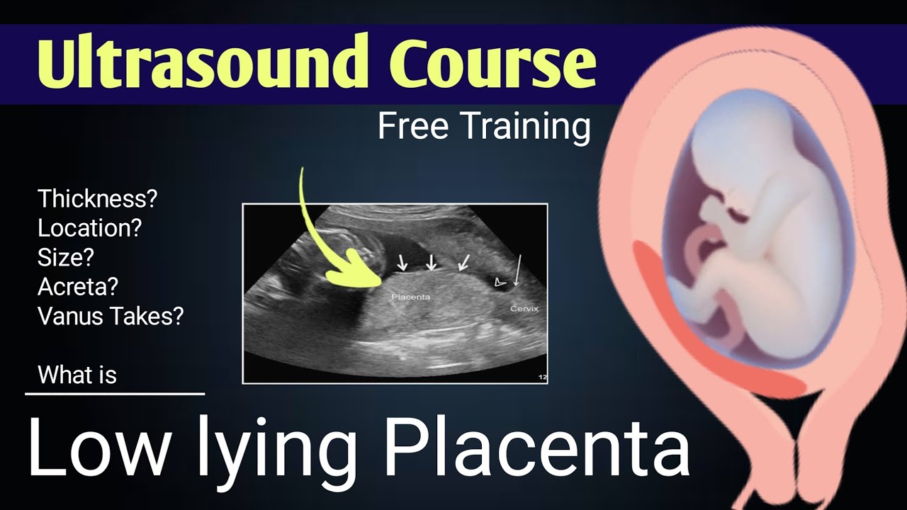Definition of Low lying Placenta by Dr Ali Waqar