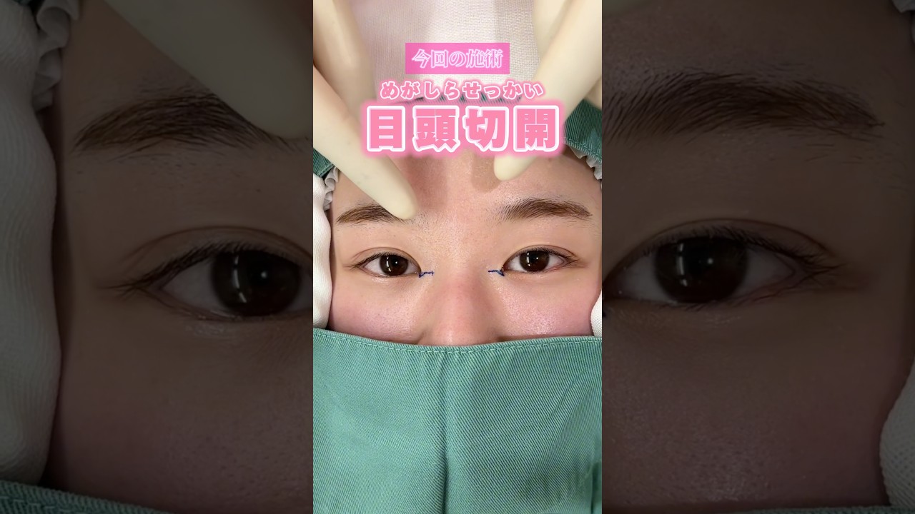 【目頭切開】寄り目にならずに自然と目を大きく👀‼ #目頭切開 #蒙古襞 #目元整形 #美容整形 #美容 #shorts