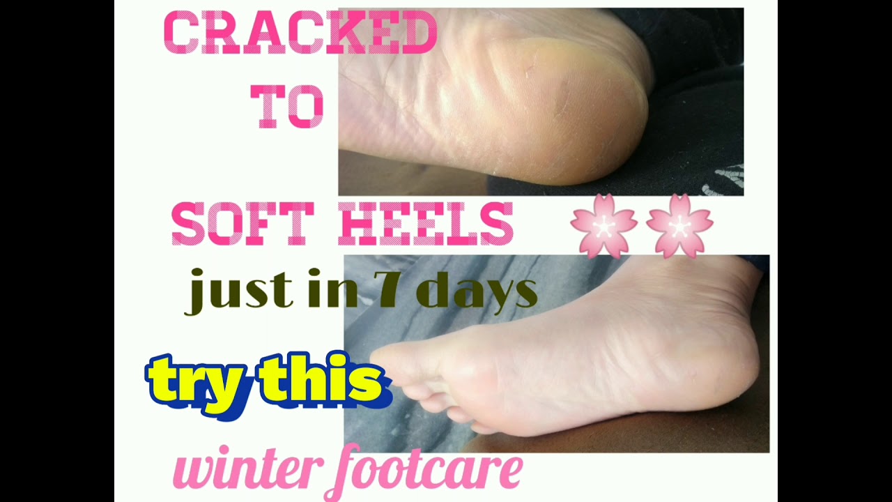 How to fix your cracked heels home remedy|| hard heels to soft heels.