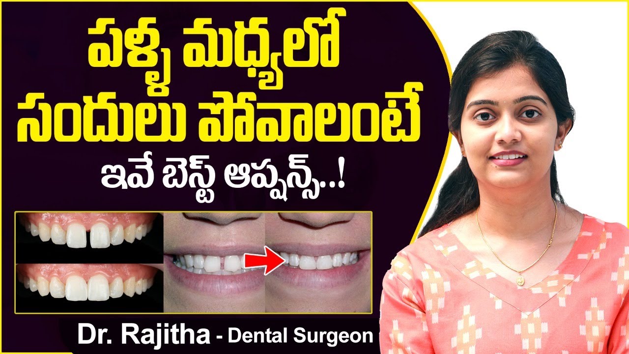 పళ్ళ మధ్య సందులు పోవాలంటే || How to Fill Gaps Between Teeth in Telugu || Eledent Dental Hospitals
