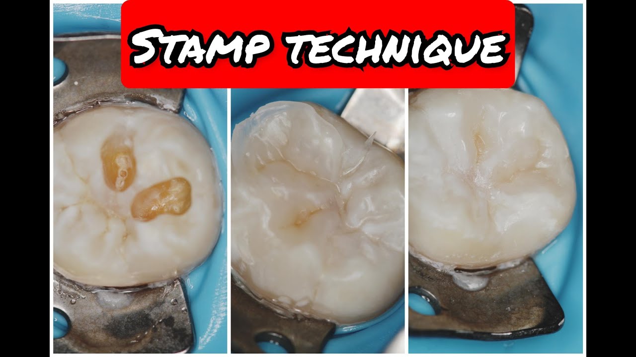 ⚠️ Occlusal stamp technique with detailed steps of selective caries removal 💯
