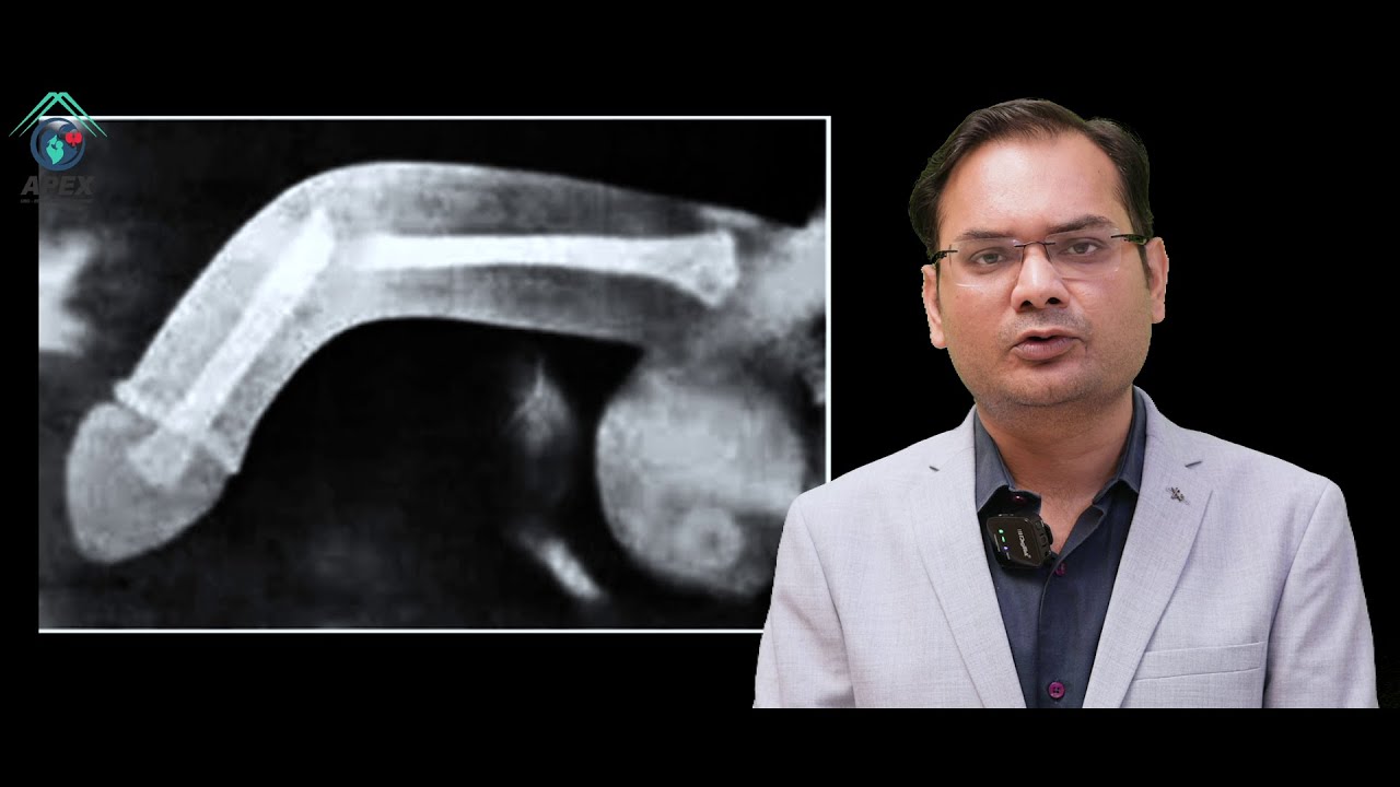 પેશાબ મા ક્રેક  થઇ ગયો પણ હવે    બિલકુલ આરામ છે