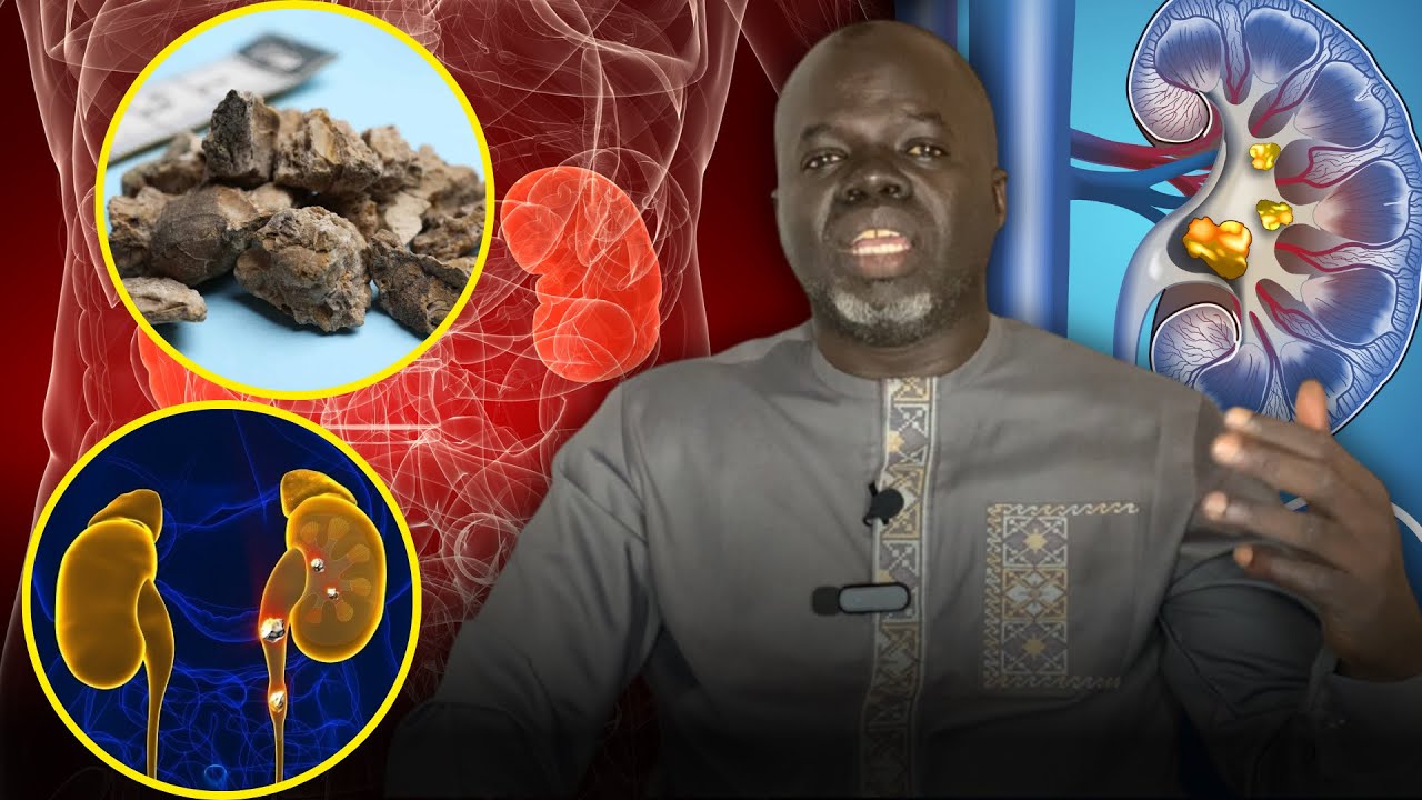 Calcul Rénal - ( Préventions et Solutions ) - Pr Ousmane Ndiaye - SAMA XALAAT TV