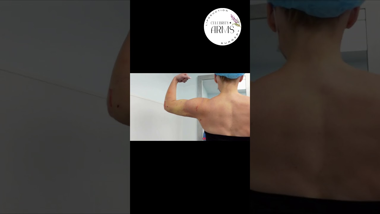 360&deg; Arm Liposuction | Celebrity Arms&trade; | Immediate Results | Expert Dr. Thomas Su | Artlipo