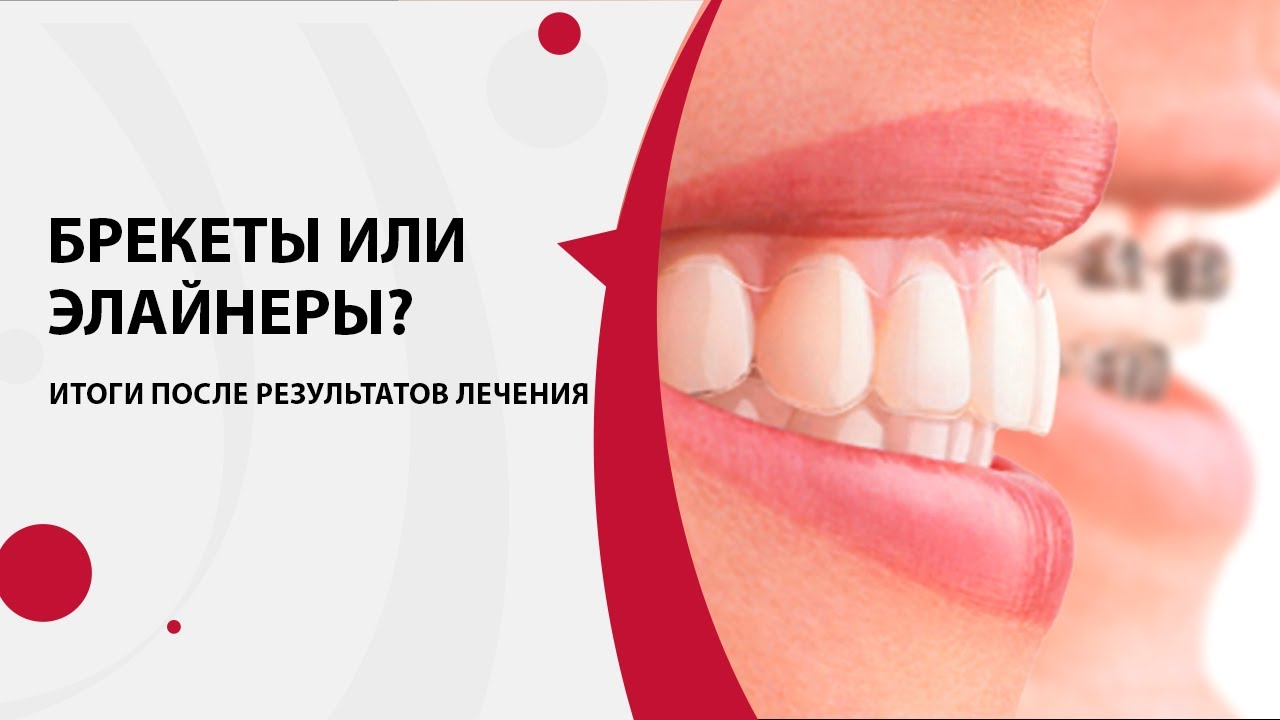 Элайнеры или брекеты? | Исправление прикуса