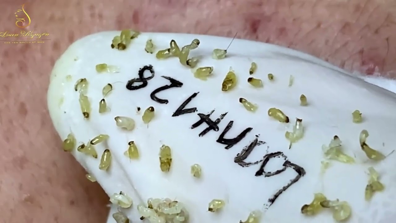 Want CLEAR SKIN? Try Loan Nguyen's Acne Treatment Now