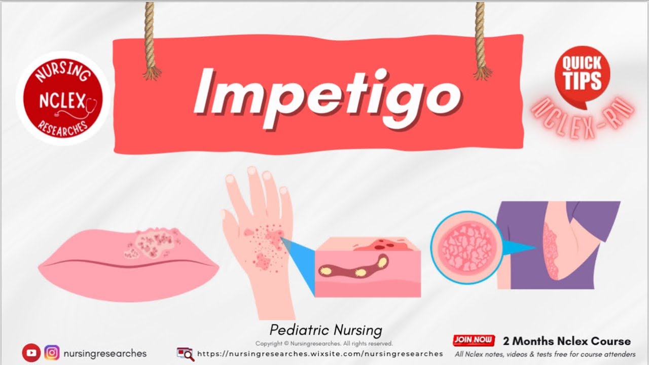 Impetigo, Pediatric Nursing Nclex Quick Tips