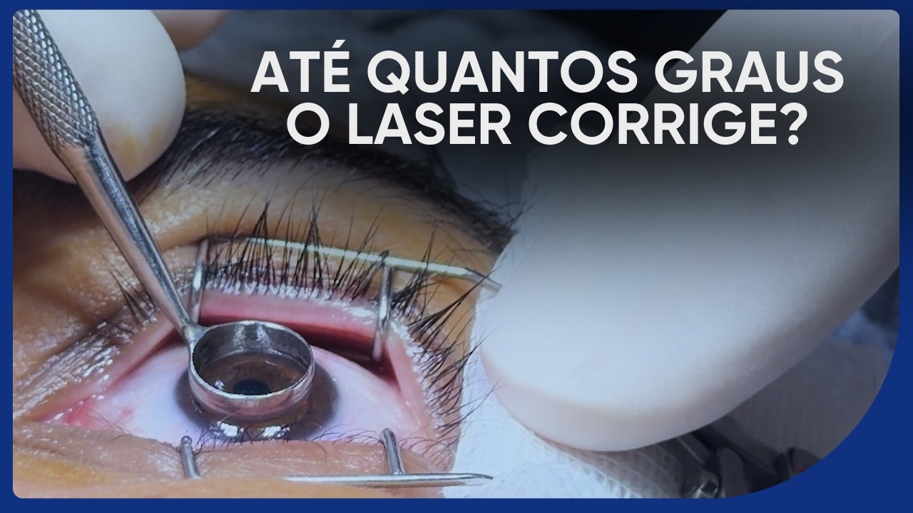 Miopia, Astigmatismo e Hipermetropia: Até quantos graus o laser corrige?