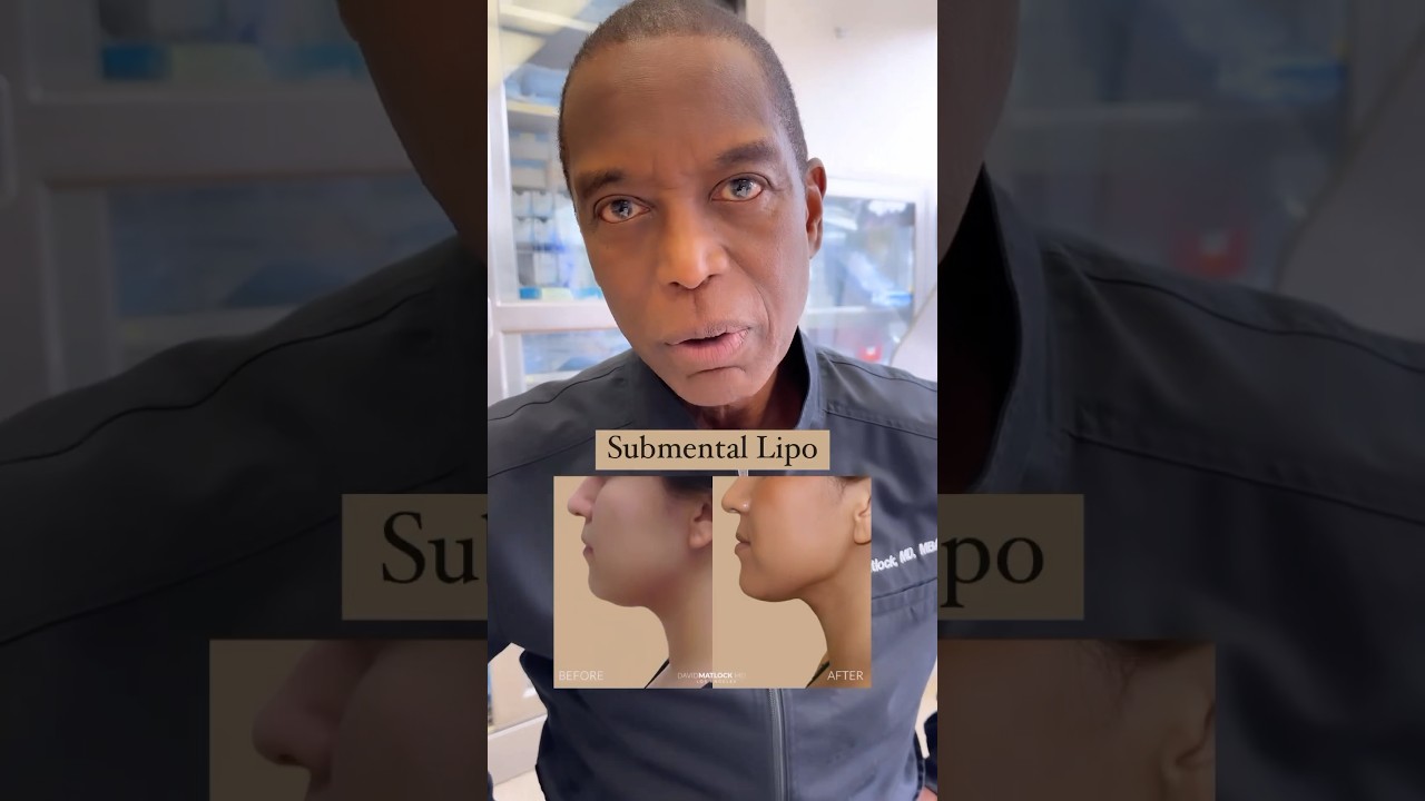 Get Rid of Your Neck Fat w/Submental Liposuction