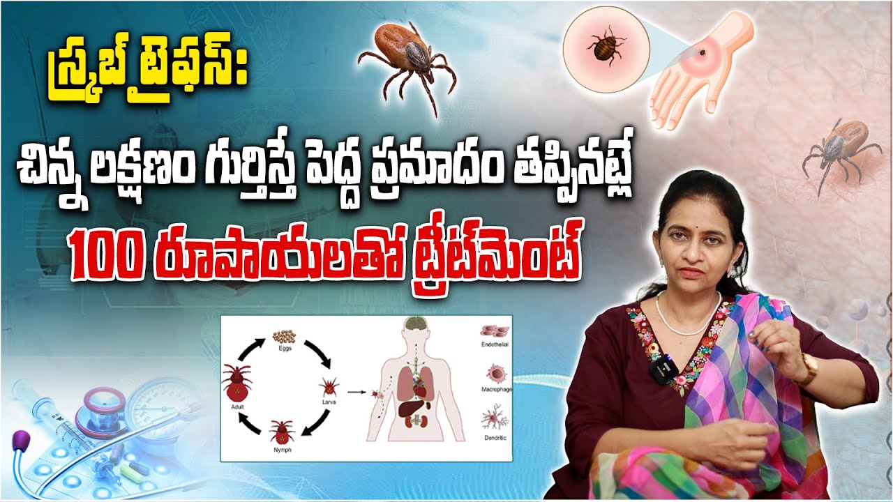 Scrub Typhus Explained: Symptoms, Early Detection & Simple Treatment | Doctor Sharmila’s Key Advice