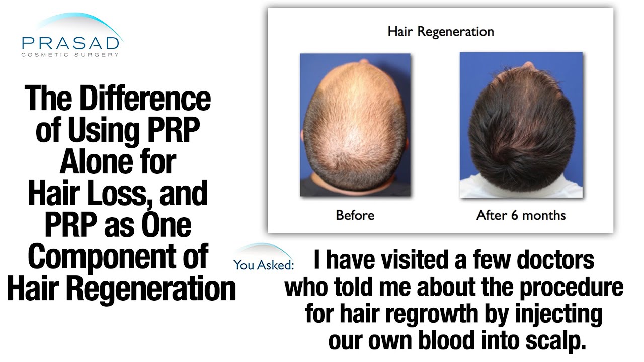 The Limitations of Using PRP Alone for Hair Loss, and its Remarkable Results when Combined