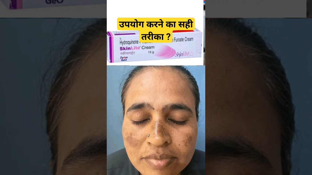 skinlite cream uses in hindi  #skincare #skin #skinlitecream