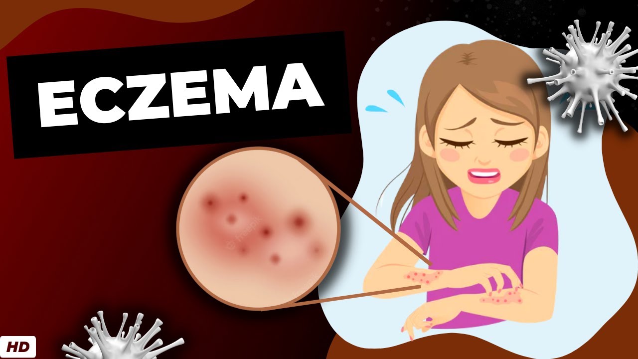 Eczema: Everything You Need To Know