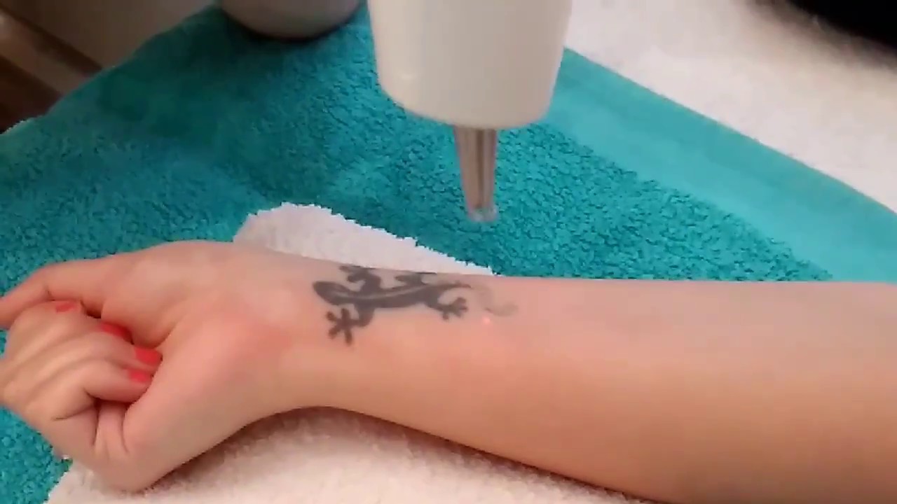 I get laser tattoo removal on my wrist!