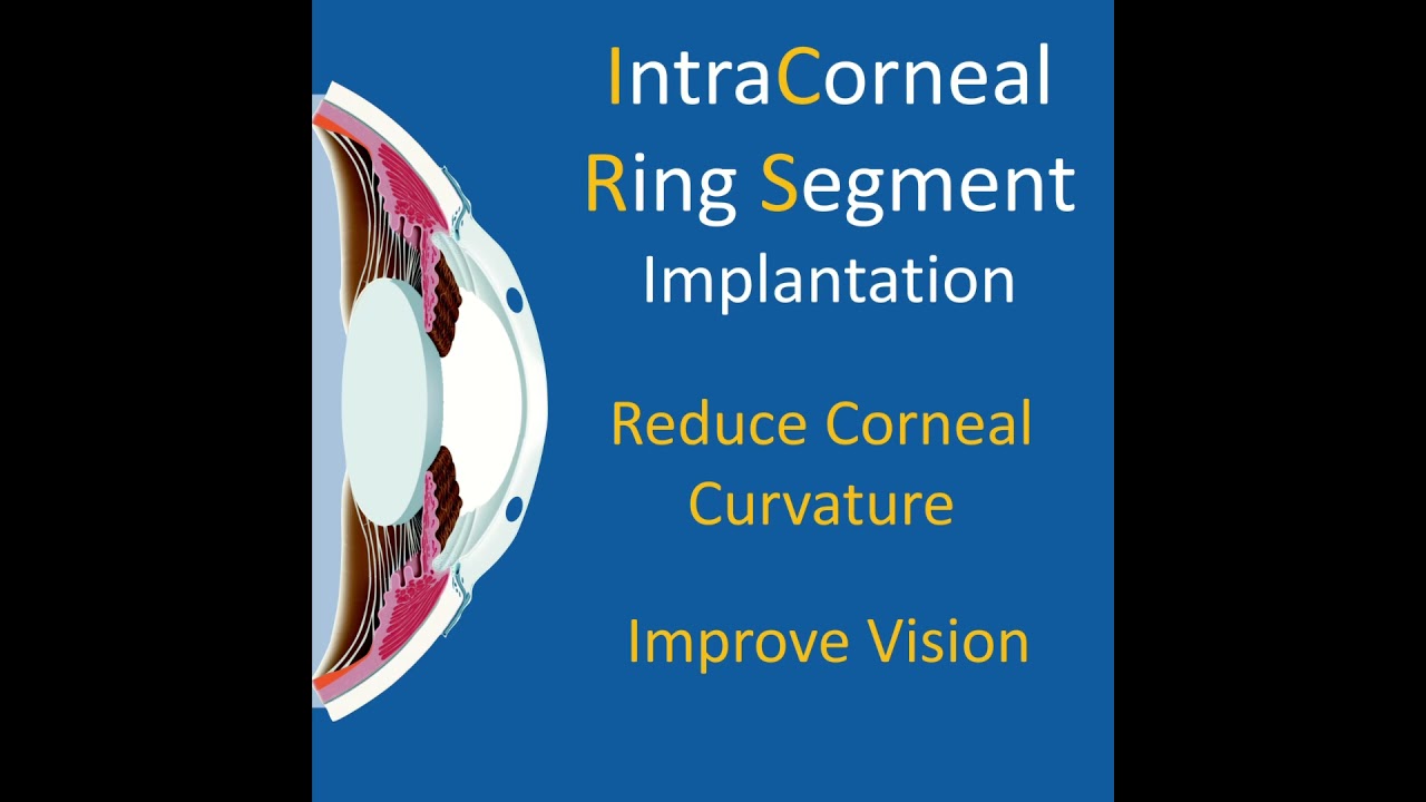 Intracorneal Ring Segment (Intacs) Implantation in Advanced Keratoconus