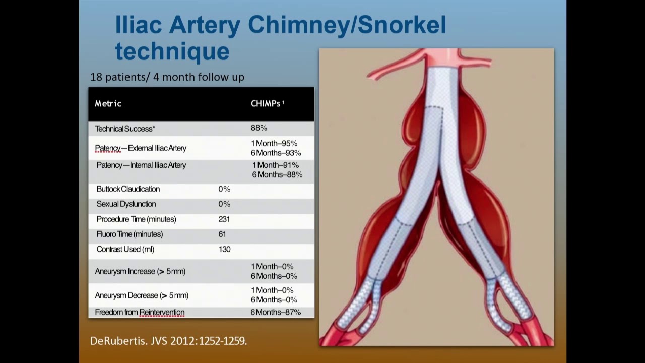 Preserving Hypogastric Flow: Branched Iliac Stent Grafts - Steve Henao, MD