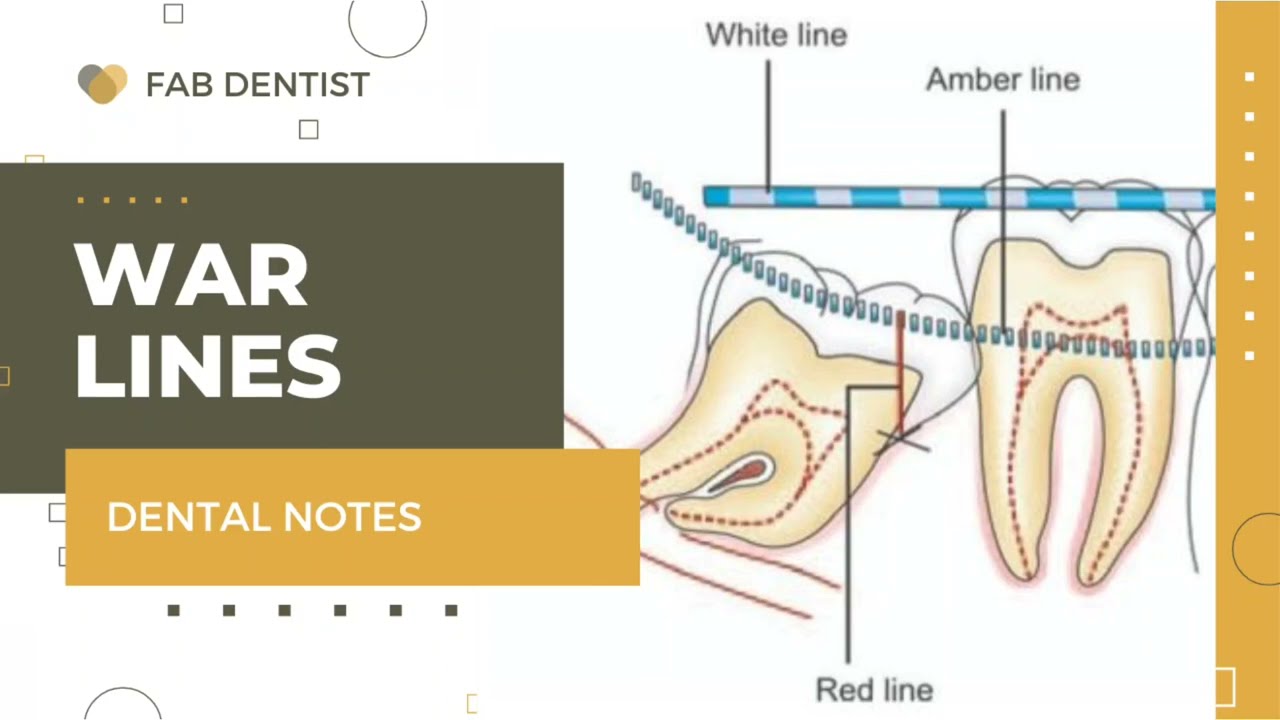 WAR LINE//IMPACTION//ORAL SURGERY