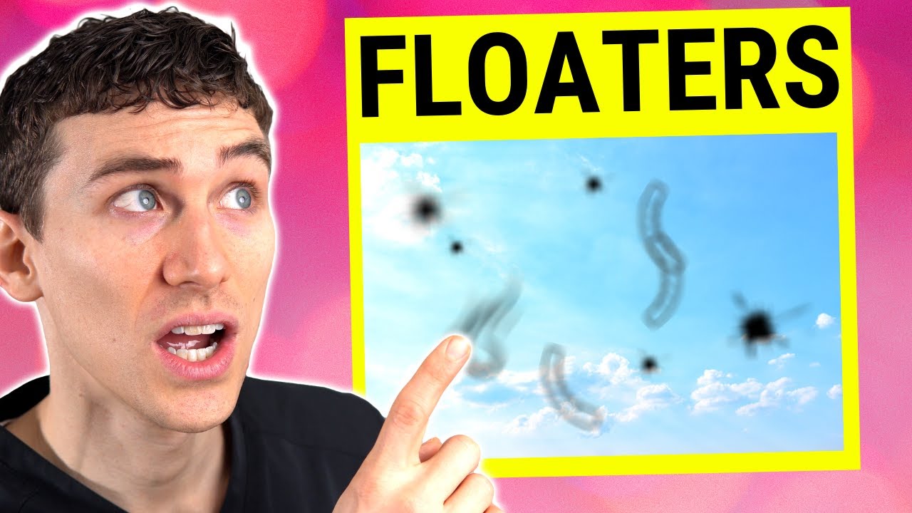 Large Eye Floaters Explained - Posterior Vitreous Detachment (PVD)